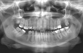 fogorvos, fogászat, fogászat pécs, panoráma röntgen, digitális fogászati röntgen