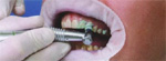 fogorvos, fogászat, fogászat pécs, eurodental, szájsebészet, fogkő eltávolítás, ultrahang