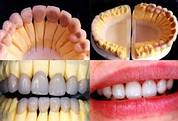 fogorvos, fogászat, fogászat pécs, eurodental, szájsebészet, koronák, hidak, cirkon korona