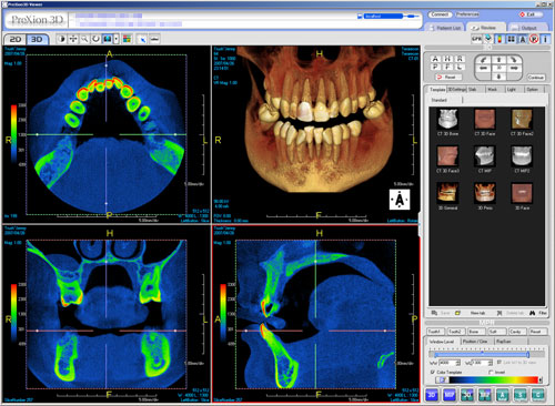 3 dimenziós fogászati tervezés, implant dent, fogászati CT, pécs, pecs