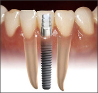 dental implant, fogszakorvos pécs, szájsebész szakorvos pécs