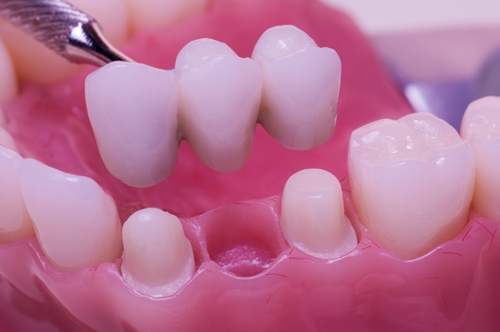 implantátum, fogászati implantátum, fogorvos pécs, fogászati ügyelet pécs