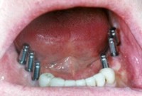 fogorvos_pécs, dental surgery pecs, implant, műgyökér, camlog, pécs, fogorvos, fogászat, camlog implant pécs