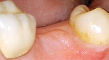 foghiany, foghiány, missing teeth, implant, pécs, pecs, fogorvos_pécs, dentist, fogorvos pecs, fogorvos pécs
