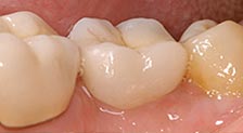 crown, dental, pécs, fogorvos_pecs, fogorvos pécs, dentist, surgery, ungarn dental, fogpótlás pécs, dental surgery