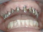 implant, műgyökér, fogbeültetés, pécs, fogorvos, ct, esztétika, korona, implantáció, dental