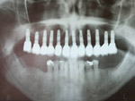 dentist, dental implant, pécs, fogorvos pécs, fogorvos pecs, fogászati ügyelet pécs