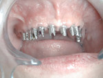 dental surgery pécs, dental, implant, pécs, implantológia pécs, fémmentes korona pécs, femmentes korona pecs