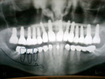 implant, pécs, implantátum pécs, fogimplant pécs, fogpótlás pécs