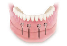 dental implant hungary, ungarn zahnarzt, mini idental implant pecs