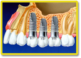 implant bridges, implantatum pecs, fogbeültetés pécs, fogászat pécs, implantatum